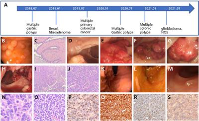 Case Report: Cancer spectrum and genetic characteristics of a de novo germline POLD1 p.L606M variant-induced polyposis syndrome